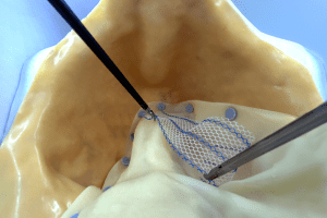 Diplomado en Simulación en cirugía laparoscópica colorrectal